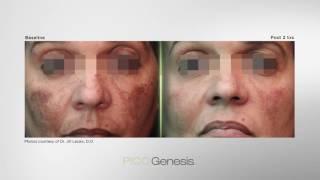 Enlighten PICO Genesis laser by Cutera