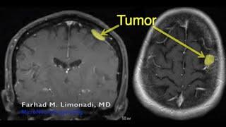 Brain Surgery: Surgical removal of right frontal meningioma