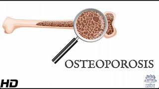 Osteoporosis: Everything You Need To Know