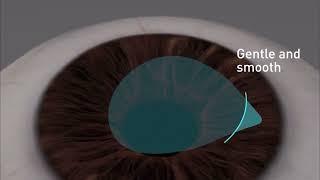 SmartSight Laser Eye Surgery - Schwind ATOS Lenticule extraction