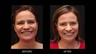 Amazing 6-Month Adult Orthodontics Results: Sandra