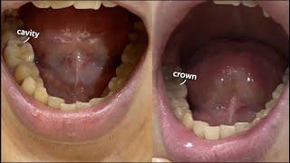 2Hearts1Seoul's Kyuho Fixes His Cavity | Seoul Guide Medical