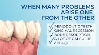 Periodontic teeth with gingival recession, bone resorption, a lot of calculus and plaque