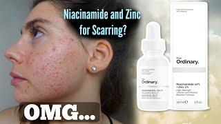 I TESTED THE ORDINARY NIACINAMIDE AND ZINC SERUM FOR MY ACNE SCARS ONE MONTH|| Shocked by this..
