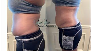 Laser Lipo W/ 14Pads 160mw Lipo Laser Machine | Before and After