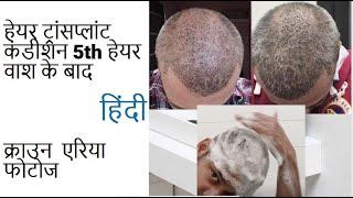 My Hair Transplant condition after 5th head wash | KV Hair Care | KV Hair Care and Life