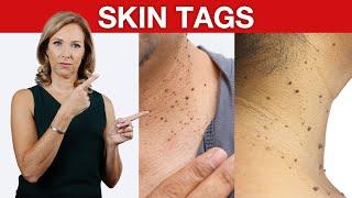 1 Thing Your Doctor NEVER Told You About Skin Tag | Dr. Janine