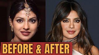 Priyanka Chopra; Plastic (Cosmetic ) Surgery  2020