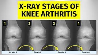 Knee Arthritis X-ray Stages: What You Need To Know