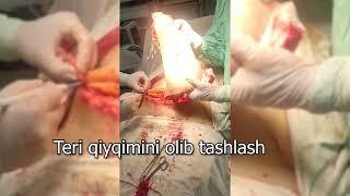 Teri qiyqimini olib tashlash  Qorin plastikasi