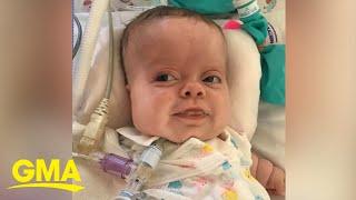 Baby with rare dwarfism goes home after 184 days in hospital l GMA Digital