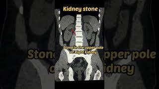 Kidney stone #kidneystone #ctscan #radiology #shorts