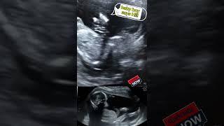 Baby says Hi!! | ultrasound 19 wks@ultrasound_cases  #baby #firstultrasound #babyultrasound