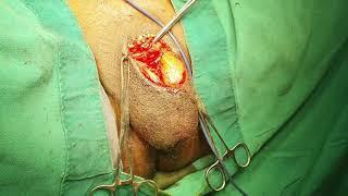 Total penectomy + perineal urethrostomy for penile cancer