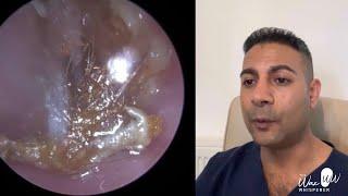 1,513 - Canal Cholesteatoma Unearthed After Difficult Ear Wax Removal