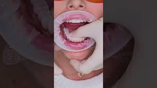 Dental implant’s All on 4 in Prague #shorts #dentist #dental #implant #veneers #short