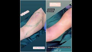 Arm Liposuction Before & After #keyhole #1hourprocedure #shorts