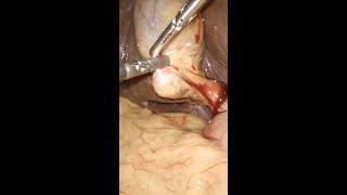 Stone-filled gallbladder during laparoscopic cholecystectomy #shorts