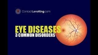 Eye Diseases | 3 Common Eye Conditions