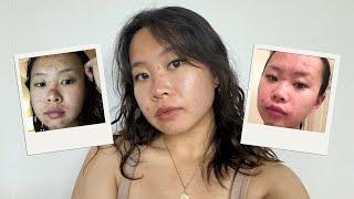 my acne journey ️‍🩹 living with acne, insecurities & how to cope