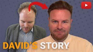 5000+ Grafts ∣ 15240 Hairs ∣ David's Hair Transplant Success Story