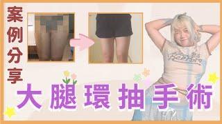 【大腿環抽｜真實見證】泡芙女孩也能有大腿縫！圓夢計畫｜整形外科蘇瑋智醫師 ft. 石見三也@kuma_yanchi