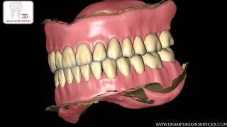 Exocad : How We Design Full Mouth Denture