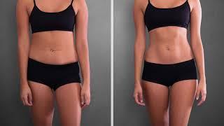 New Vitality Medical -- SculpSure Body Contouring Laser Device