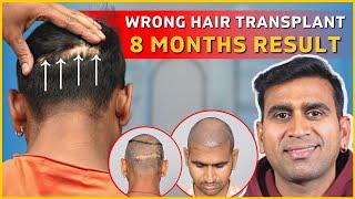 FUE Hair Transplant Results | QHT FUE Hair Transplant Results | FUT | Repair Hair Transplant | QHT