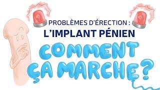 Problème d'érection? L'implant pénien gonflable expliqué aux patients par le  Dr Lipsker-Urologue.