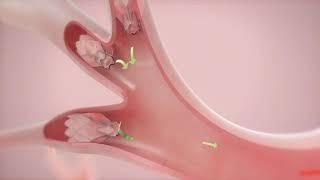 How It Works: Zephyr Valve Treatment for COPD & Emphysema