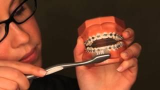 Brushing and Flossing While Wearing Braces: Alexandria Orthodontist Dr Lu