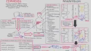 Liver Cirrhosis (SandS, Pathophysiology, Investigations, Management)