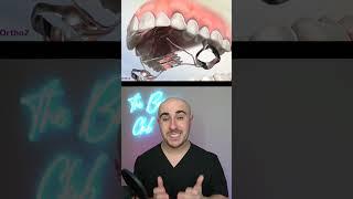 Braces Expander Explained #shorts