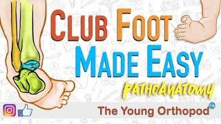 CLUB FOOT Pathoanatomy Made Easy - The Young Orthopod