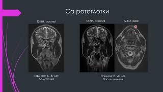 Семенова М.Д. «МРТ в диагностике и оценке эффективности лучевого лечения опухолей головы и шеи»