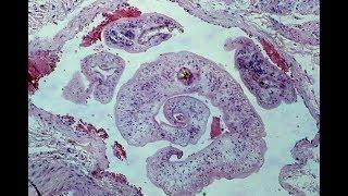 Schistosomiasis - Pathology mini tutorial