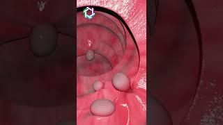 Colonoscopy Procedure: See What Happens & how it works | Dr Jitesh Rajpurohit