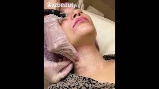 Укрепление кожи шеи мезонитями