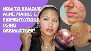 How to remove acne scars and pigmentations using derma stamp