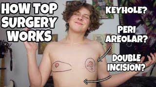 HOW TOP SURGERY WORKS (FTM TRANSGENDER) | NOAHFINNCE