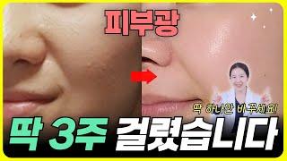 ⭐내돈내산⭐ 의사 스킨케어루틴 피부 뒤집혔을 때 '이거' 하지마세요 좁쌀여드름 탈출 피부광나는 팁 전부공개‼️