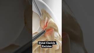 Shaving your clavicle to stop shoulder pain (3D Animation)