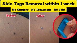 How to Remove Skin Tags in 1 Week  - No Pain, No Surgery, No Treatment / Skin Tag Removal Kit Review