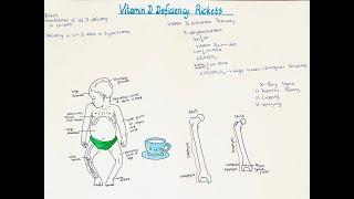 Rickets, Vitamin D deficiency in children! Bone manifestation, signs and symptoms. High yield info