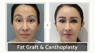 Fat Graft (Facial Fat Transfer) & Lateral Canthoplasty | VIP Plastic Surgery, Seoul, Korea