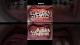 Croked teeth brcaes #braces #orthodontist #dental #dentistry