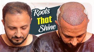 Best Hair Transplant Clinic in Hyderabad (My Experience)  | New Roots