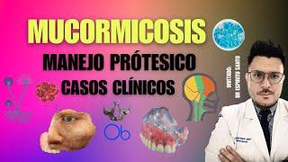 Manejo Protésico de MUCORMICOSIS    con Dr Federico Espiritu Santo Gomez