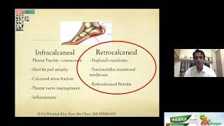 OrthoTV Original - Pain in the Heel - Management Options - Dr Abhishek Kini